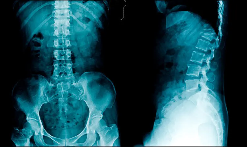 radiograf&iacute;a lumbosacra