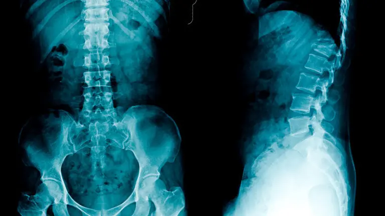 radiograf&iacute;a lumbosacra